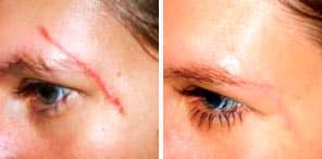 SCAR TISSUE REPAIR patient before and after photo