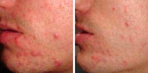 ACNE REDUCTION patient before and after photo