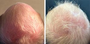 HAIR RESTORATION patient before and after photo