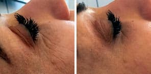 WRINKLE REDUCTION patient before and after photo