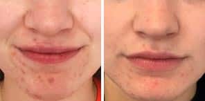 ACNE REDUCTION patient before and after photo