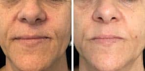 SKIN REJUVENATION patient before and after photo