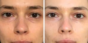 DARK CIRCLES patient before after photo