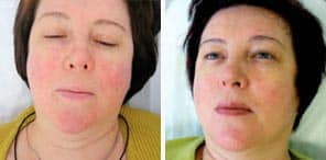 ROSACEA TREATMENTS patient before and after photo