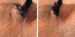 WRINKLE REDUCTION patient before and after photo