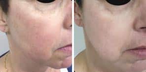 VASCULAR LESIONS patient before and after photo