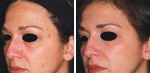 BENIGN PIGMENTED LESIONS patient before and after photo