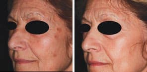 BENIGN PIGMENTED LESIONS patient before and after photo