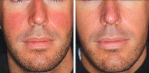 VASCULAR LESIONS man patient before and after photo