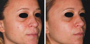 VASCULAR LESIONS and BENIGN PIGMENTED LESIONS woman patient before and after photo