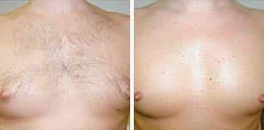 PERMANENT HAIR REDUCTION man patient before and after photo