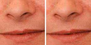 PERMANENT HAIR REDUCTION patient before and after photo