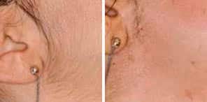 PERMANENT HAIR REDUCTION patient before and after photo