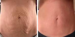 EXCESS LOOSE SKIN/SKIN TIGHTENING patient before and after photo