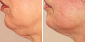 WRINKLED/SAGGING SKIN REDUCTION patient before and after photo