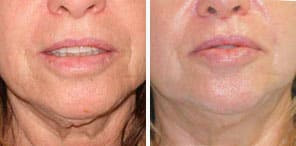 WRINKLED/SAGGING SKIN REDUCTION patient front photo