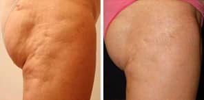 CELLULITE REDUCTION patient before and after photo