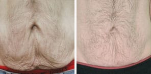EXCESS LOOSE SKIN/SKIN TIGHTENING another patient before and after photo