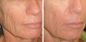 WRINKLED/SAGGING SKIN REDUCTION patient before and after photo